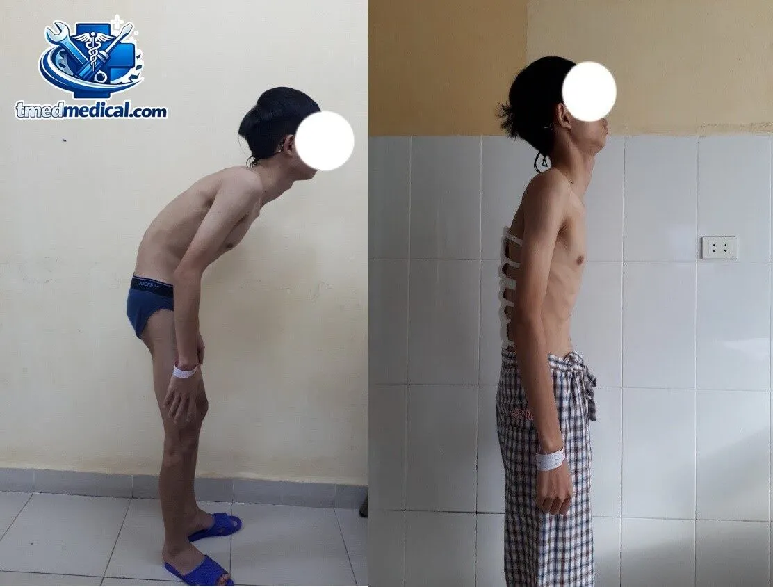 tư thế siêu anh hùng giúp tăng cường cơ lưng chống gù lưng